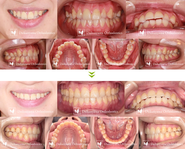 マウスピース矯正の症例