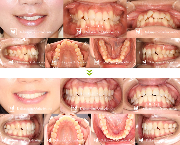 女性のマウスピース矯正ビフォーアフター
