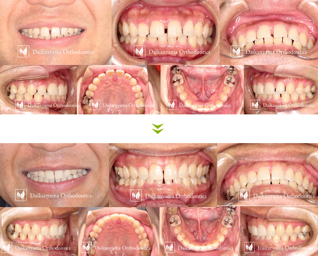 男性のマウスピース矯正症例
