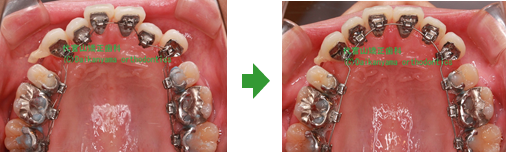 大人の裏側矯正の症例